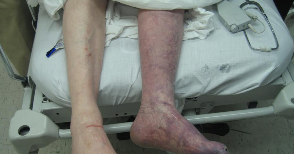  Ischemic Pain